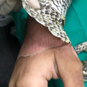 Pele de tilápia é usada em tratamento de queimaduras em hospital do Rio