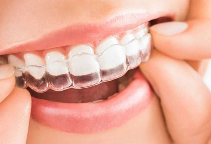 Saiba tudo sobre o Invisalign