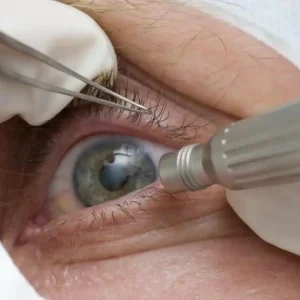 Cirurgia para mudar a cor dos olhos: como funciona e quais os riscos?