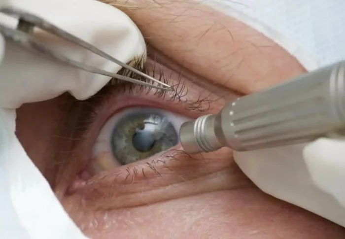 Cirurgia para mudar a cor dos olhos: como funciona e quais os riscos?